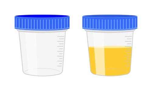 What Type of Container Is Used for Urine Collection?
